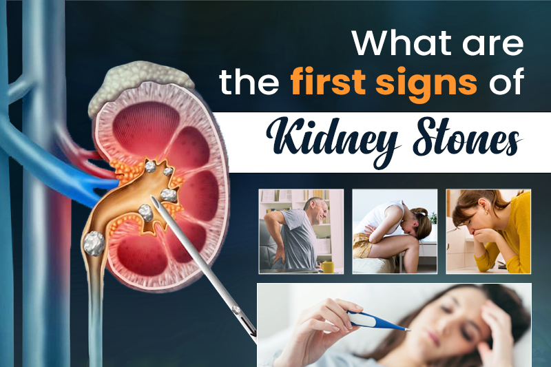 What are the First Signs of Kidney Stones